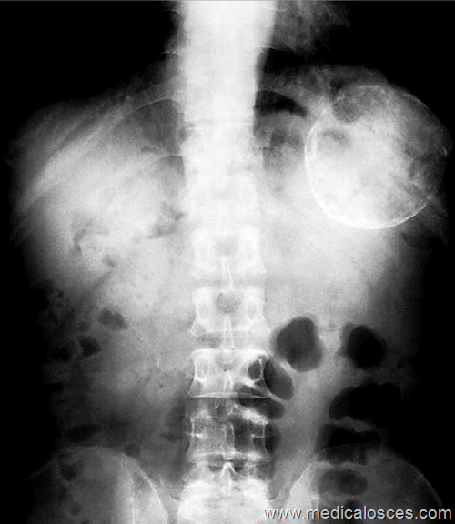 The plain abdominal film shows a large circular calcified lesion in the